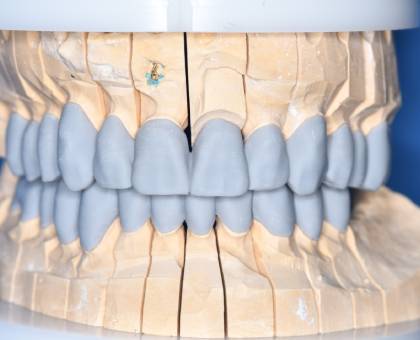 Bezmetalne krunice i mostovi Krusevac Stomatoloska ordinacija Dental home