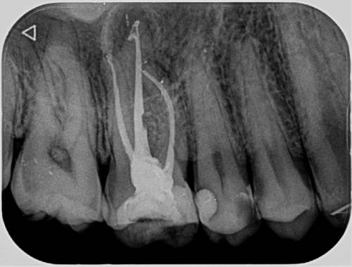 Lečenje korena zuba-mašinska endodoncija kontrolisano rengen snimkom ili cbct.