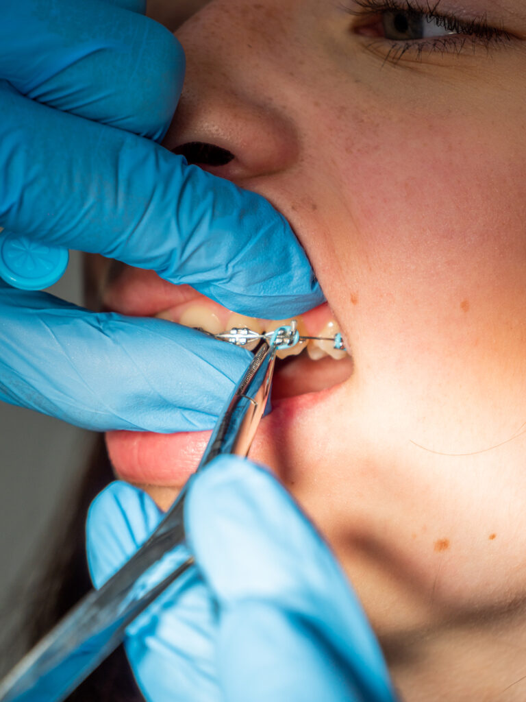 Fiksne proteze stomatoloska ordinacija Dental Home Kruševac