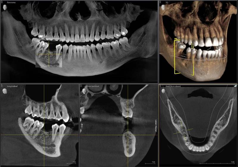 Zubna ordinacija Kruševac Dental Home All on 4 All on 6