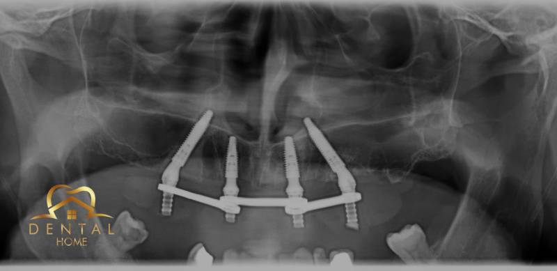 Zubna ordinacija Kruševac Dental Home All on 4 All on 6