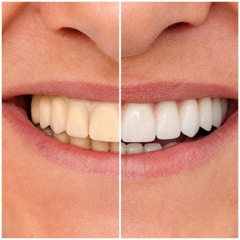 Zubna ordinacija Kruševac Dental Home All on 4 All on 6